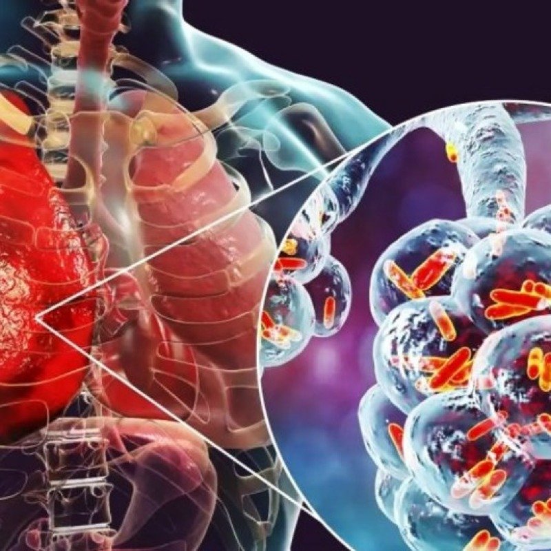 Ötən il Azərbaycanda pnevmoniyadan 400-dən çox şəxs ölüb
